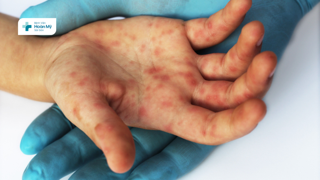 Cảnh báo tăng ca mắc tay chân miệng: Dấu hiệu nhận biết và cách phòng ngừa