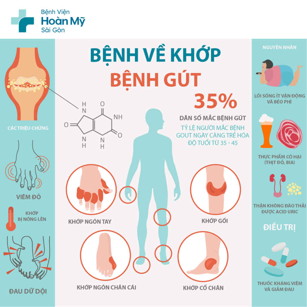Điều trị bệnh Gout hiệu quả tại Bệnh viện Hoàn Mỹ Sài Gòn