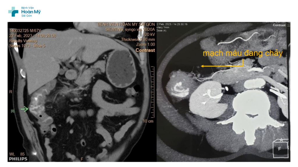Can thiệp nội mạch cầm máu cho người đàn ông xuất huyết ồ ạt do biến chứng của viêm túi thừa đại tràng