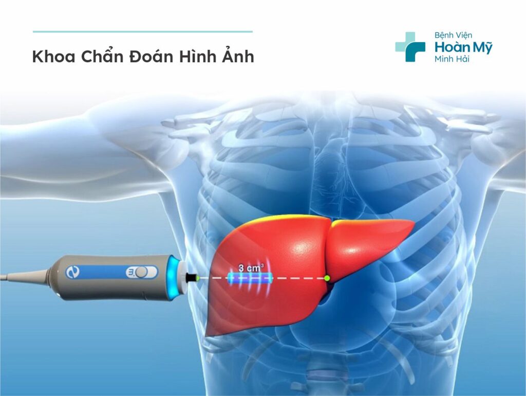Siêu âm đàn hồi mô gan