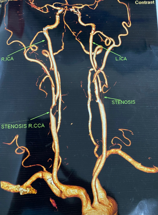 Coronary Artery Plaque Successfully Treated in Elderly Patient With History Of Stroke