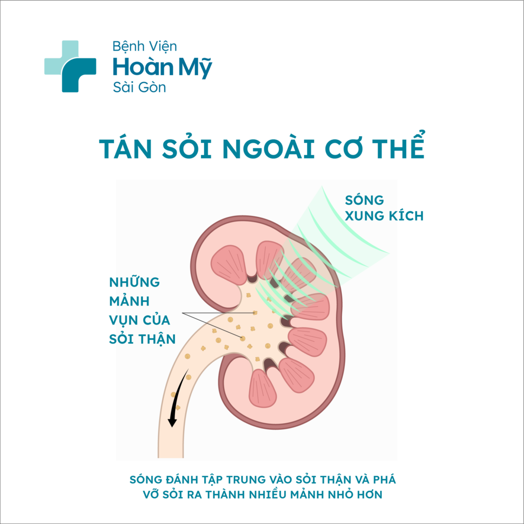 Những lưu ý khi thực hiện tán sỏi ngoài cơ thể