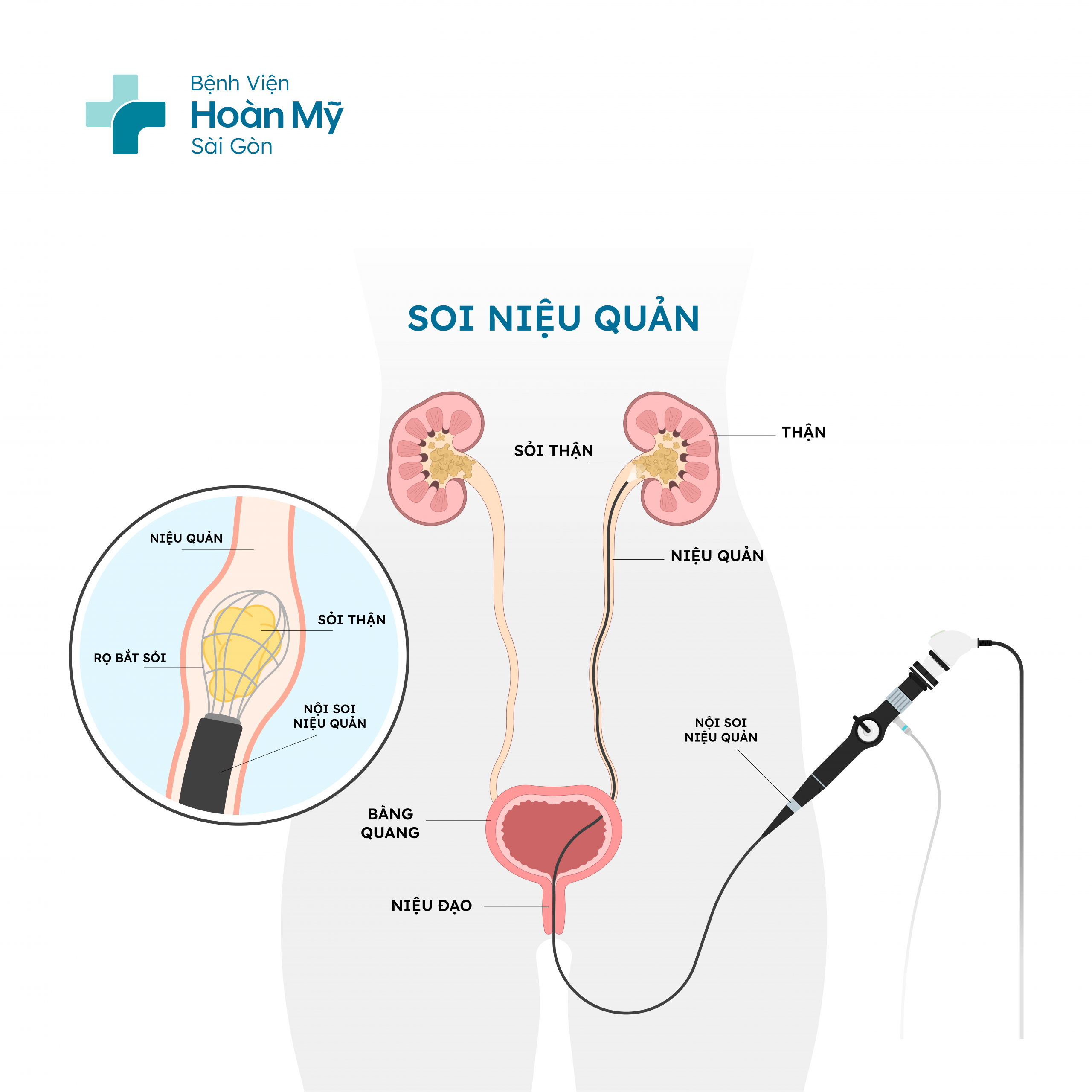 Điều trị sớm Sỏi niệu quản để tránh các biến chứng về thận