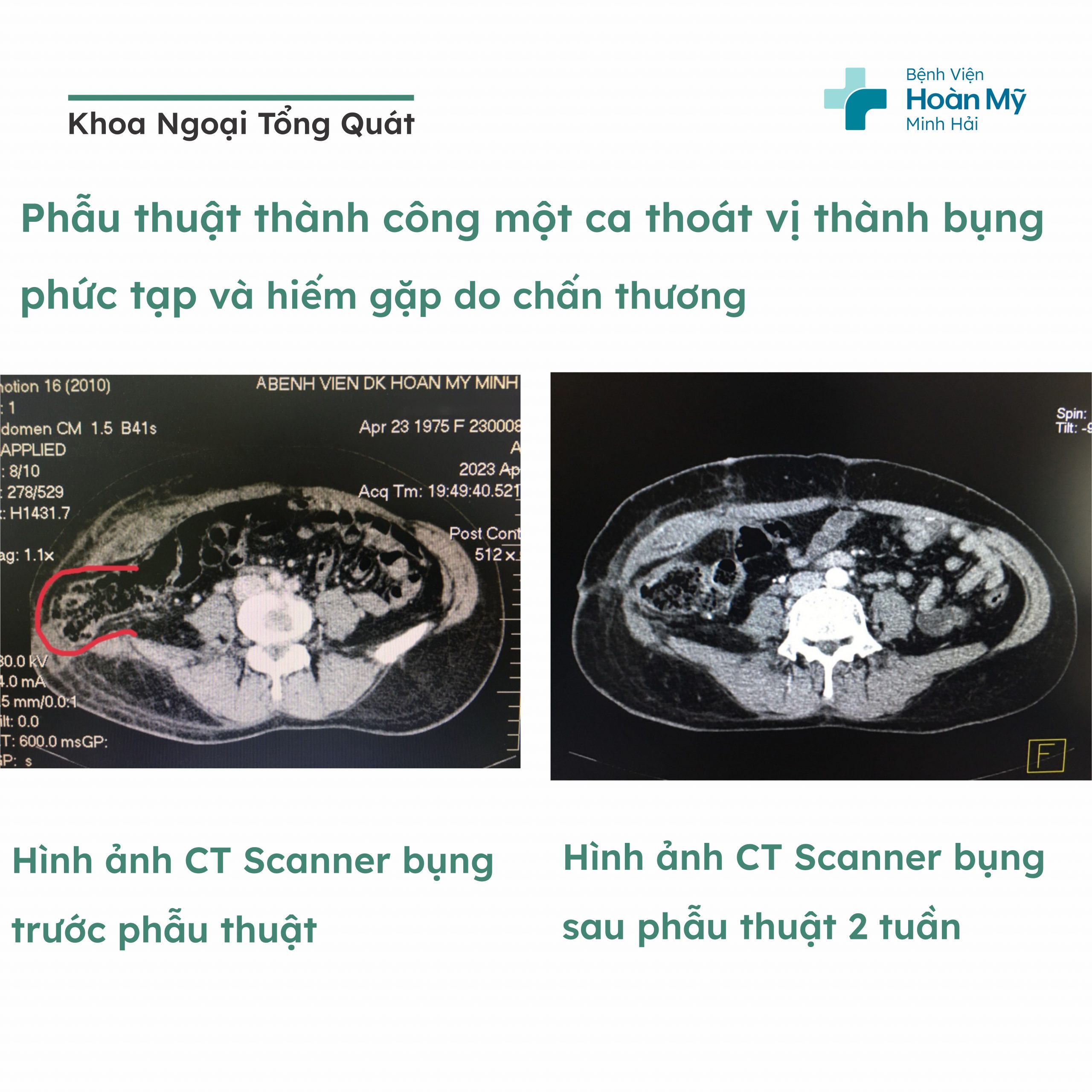 Phẫu thuật thành công một ca thoát vị thành bụng phức tạp và hiếm gặp do chấn thương