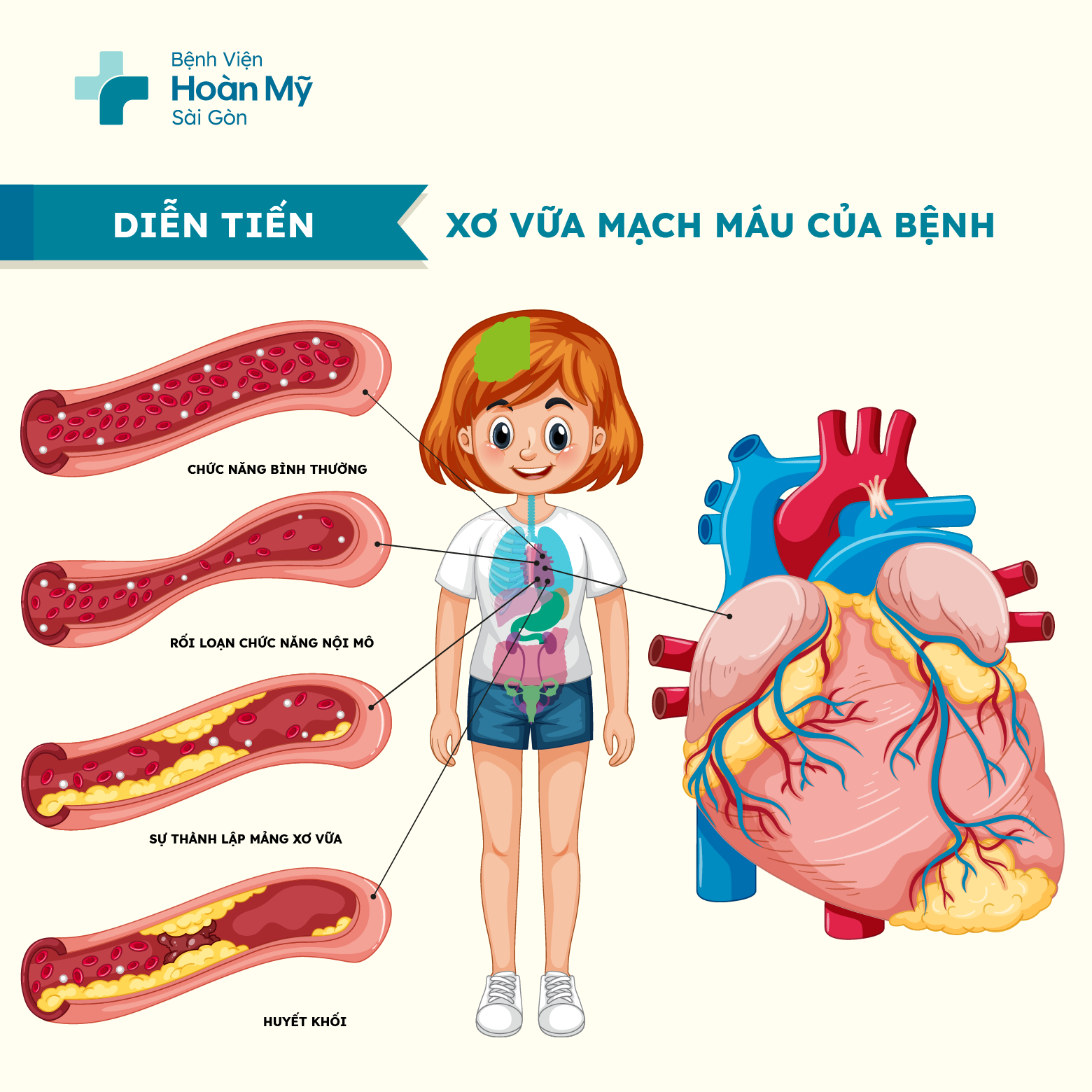 Bệnh động mạch vành là gì? Nguyên nhân và cách điều trị