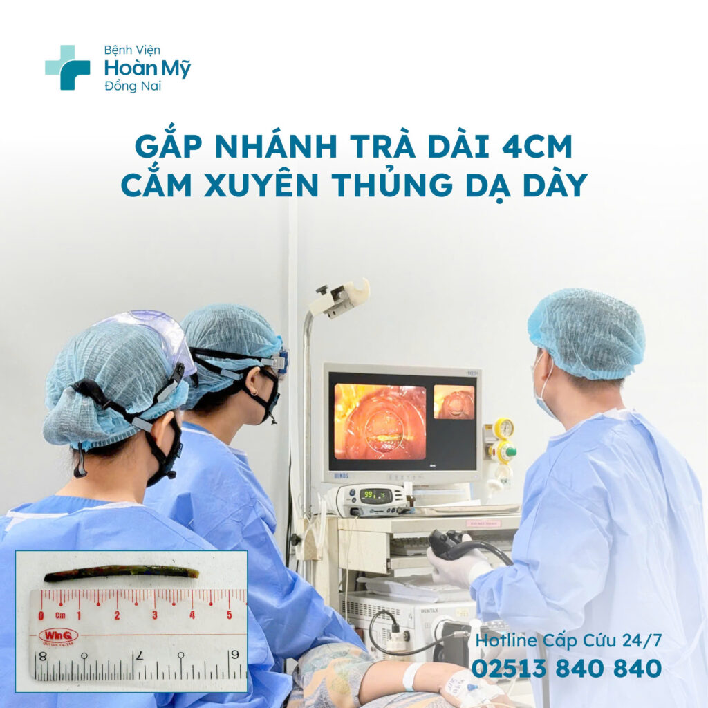 Gắp nhánh trà dài 4cm cắm xuyên thủng dạ dày cho nữ bệnh nhân ở Biên Hòa