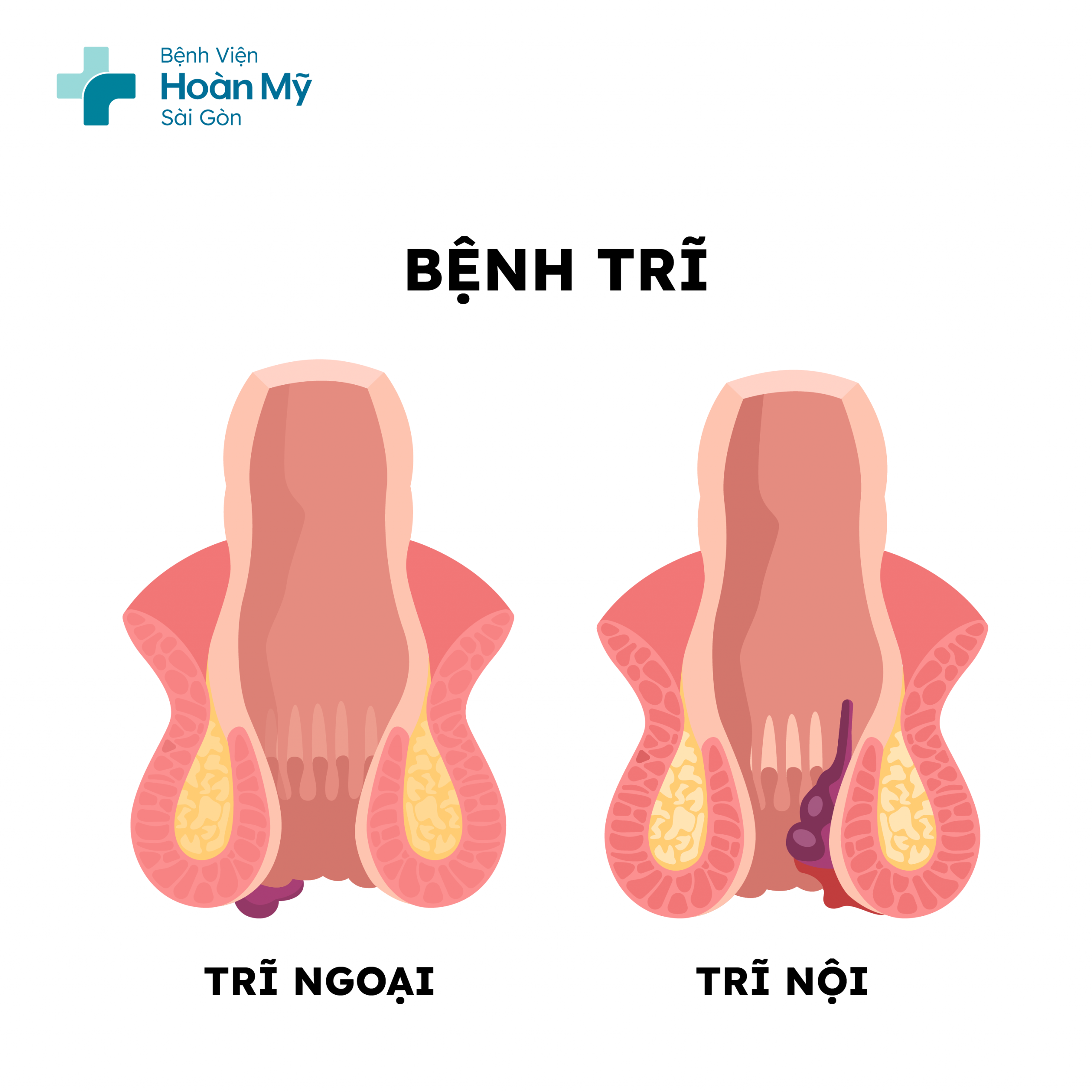 Có 2 loại bệnh trĩ là trĩ nội và trĩ ngoại