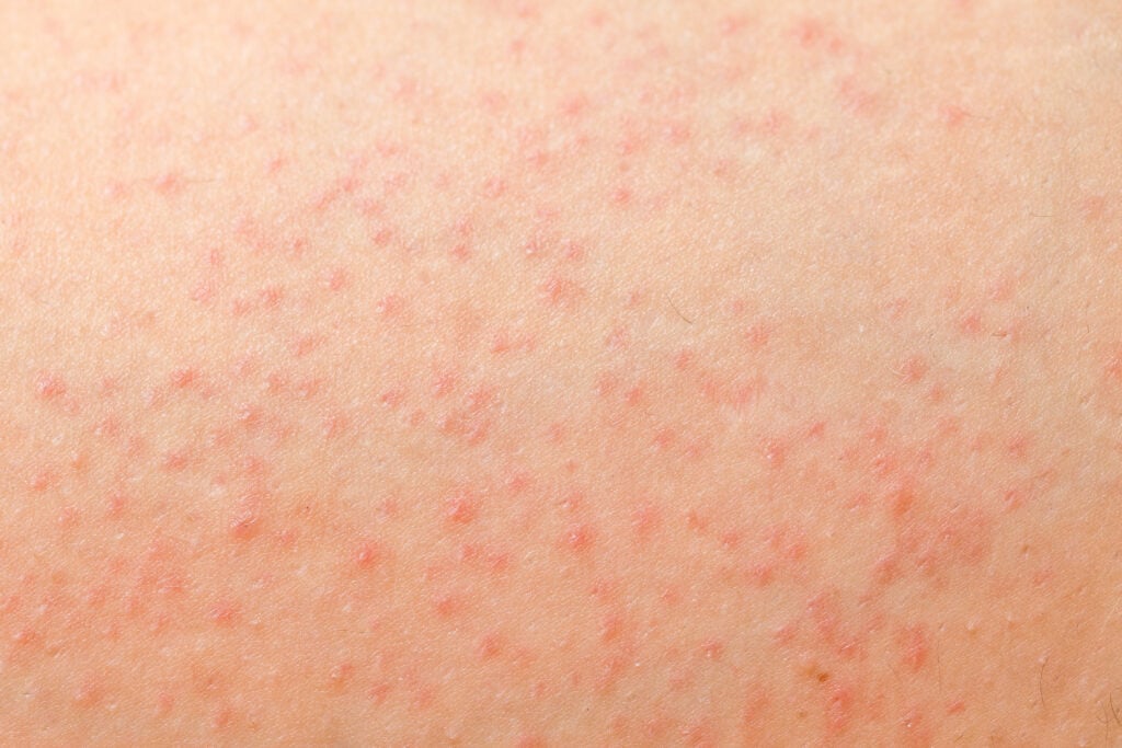 Viêm nang lông là một trong những biểu hiện cho thấy cần thải độc da nhiễm corticoid (Nguồn: Internet)