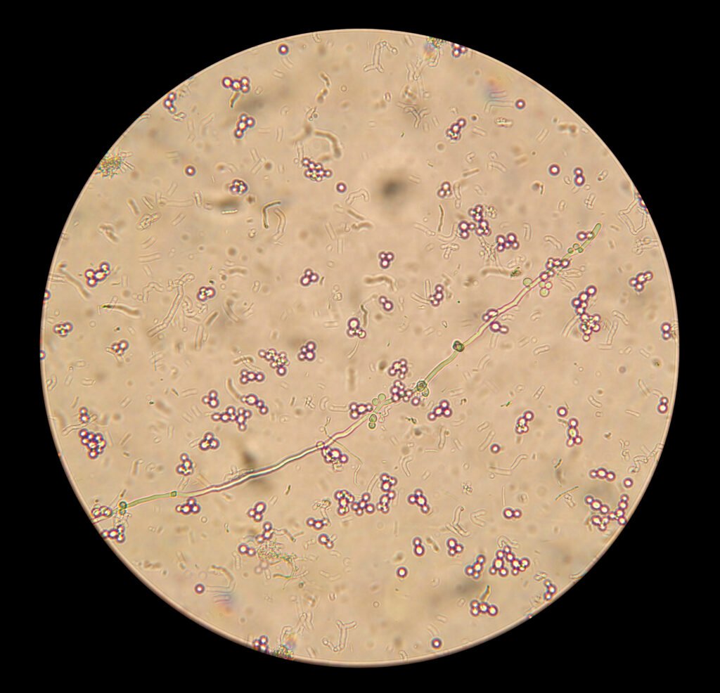 Bệnh nấm miệng