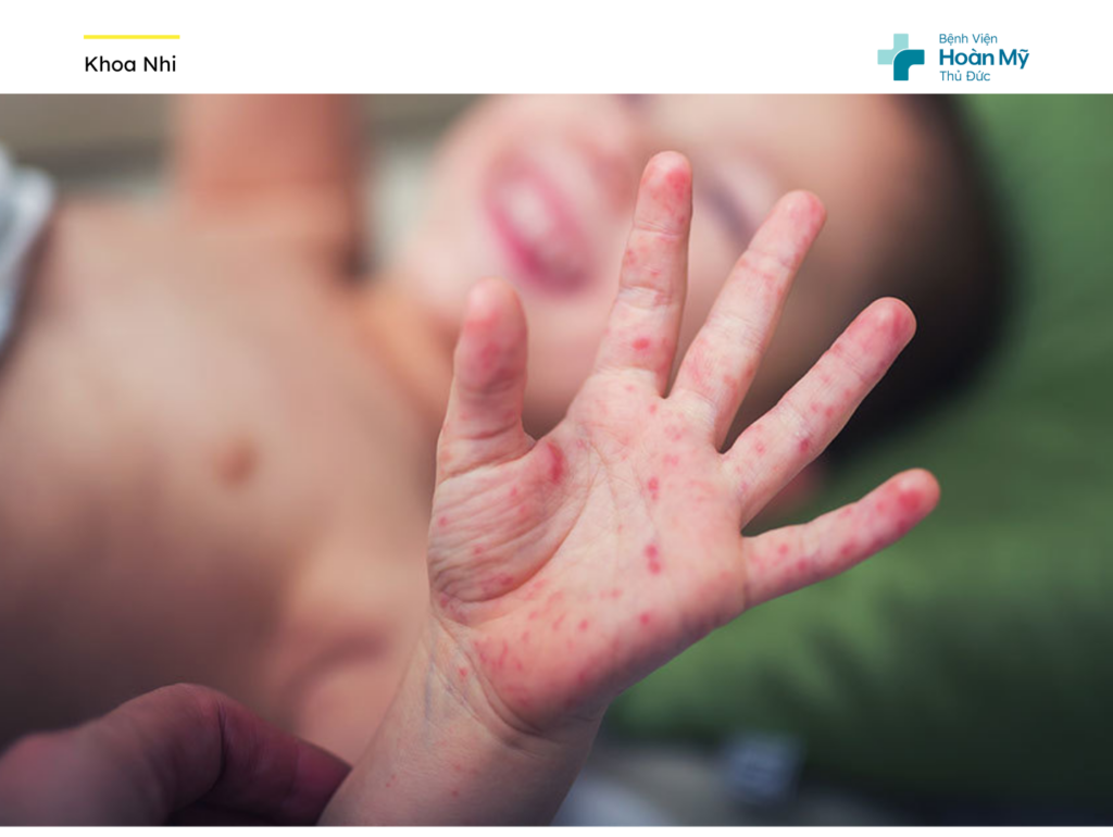 Cảnh báo bùng phát dịch tay chân miệng: Những điều ba mẹ cần lưu ý