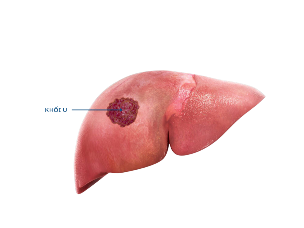 Ung thư gan: Có thể phòng ngừa và phát hiện sớm bệnh