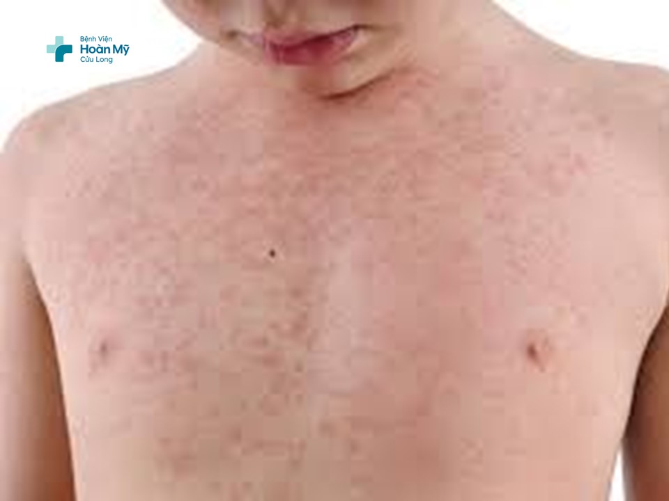 Tìm hiểu về bệnh sởi ở trẻ em