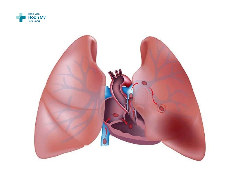 Tắc động mạch phổi cấp