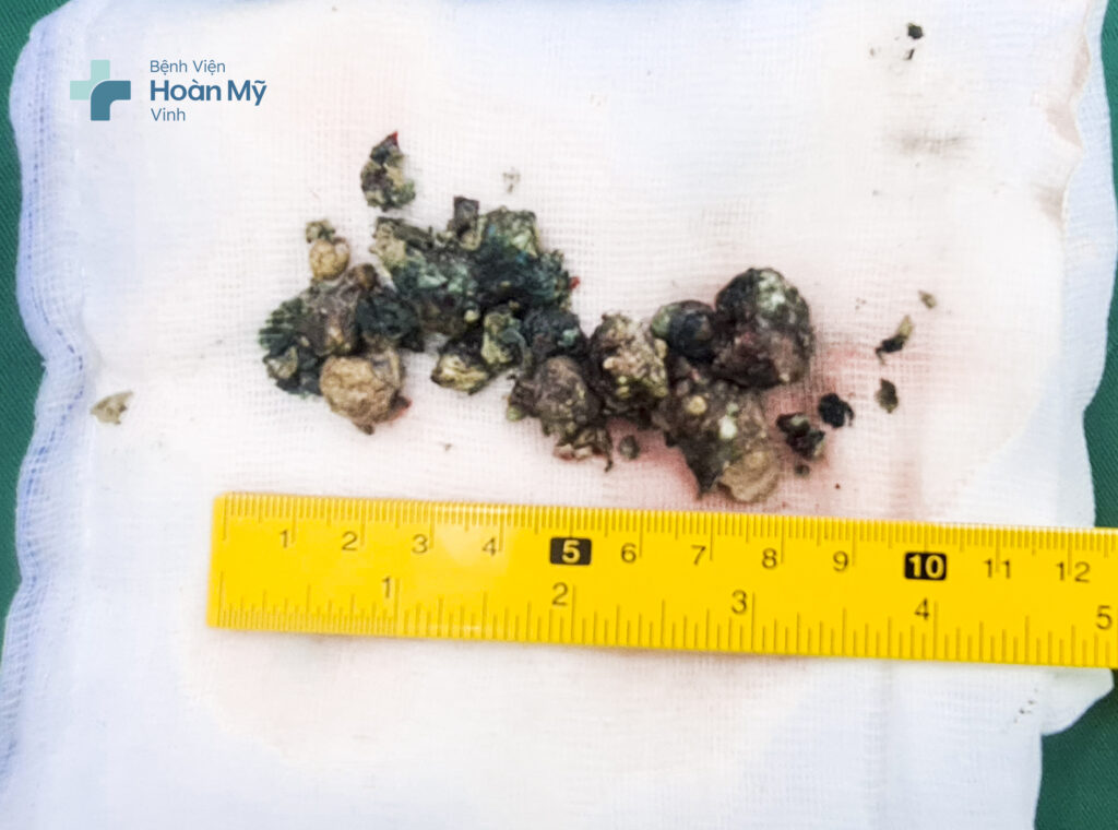 Sỏi san hô trong thận