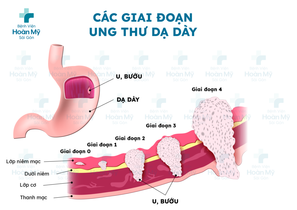 Phát hiện sớm ung thư dạ dày để điều trị hiệu quả