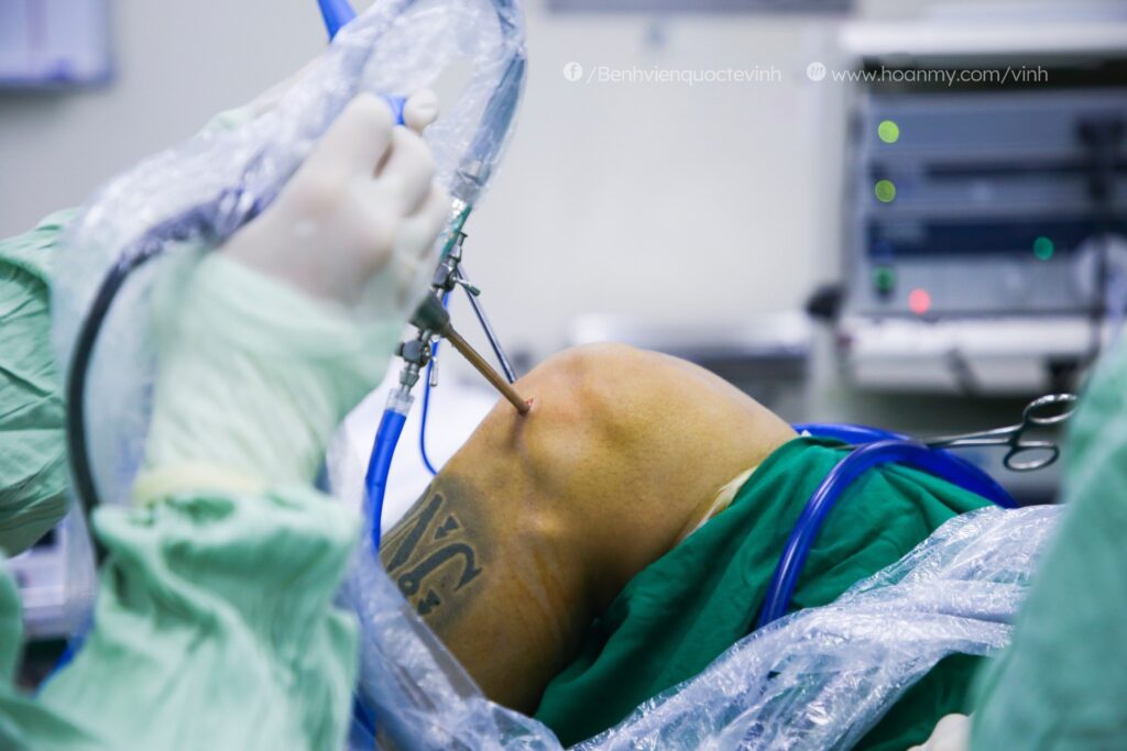 Chơi thể thao trở lại sau phẫu thuật nội soi tái tạo dây chằng chéo khớp gối