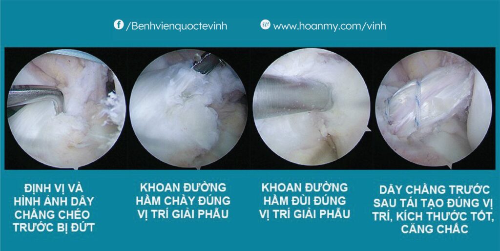 Chơi thể thao trở lại sau phẫu thuật nội soi tái tạo dây chằng chéo khớp gối