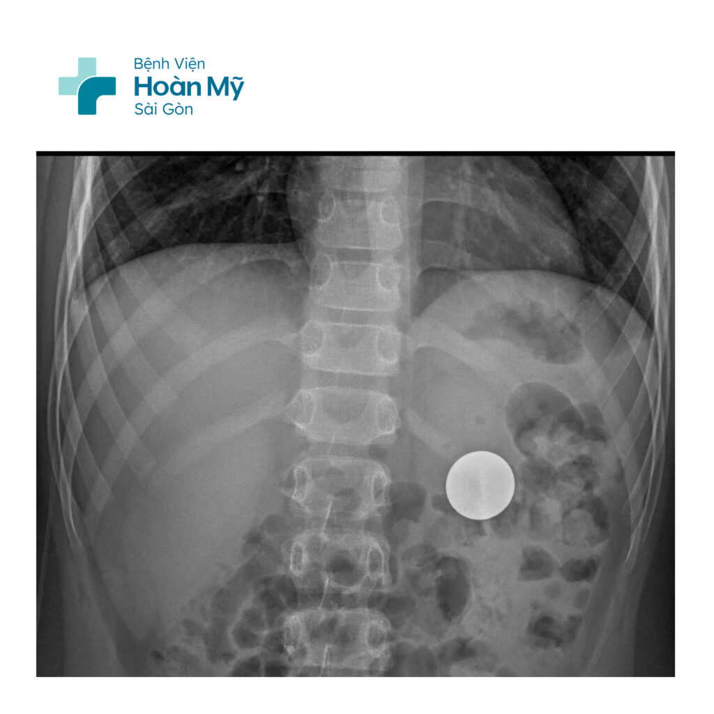 Gắp đồng xu đường kính 4cm trong dạ dày bệnh nhi 11 tuổi