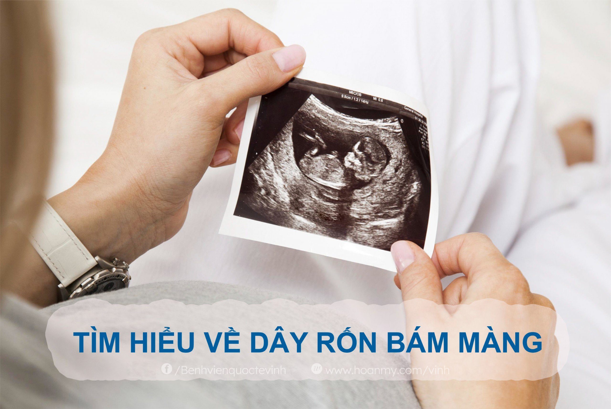 Dây rốn bám màng