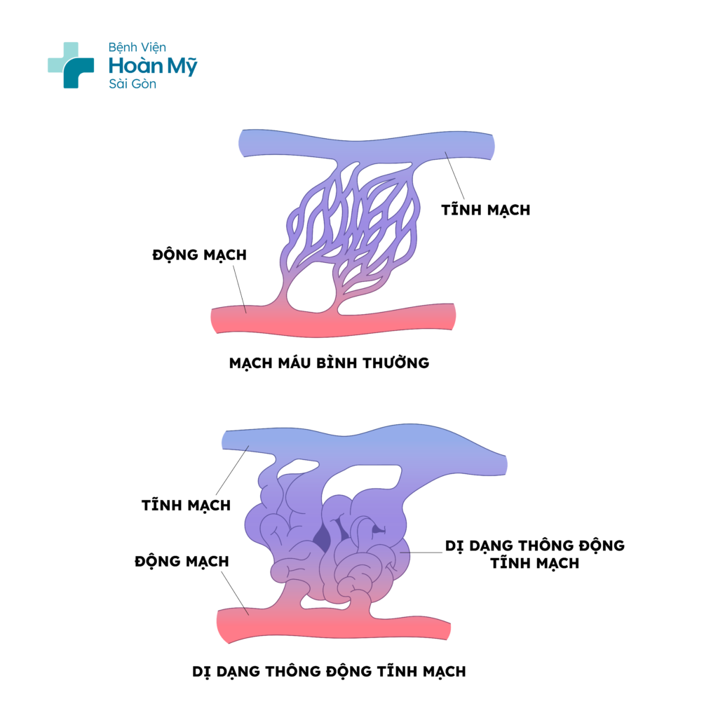 Cách điều trị dị dạng mạch máu não an toàn và hiệu quả