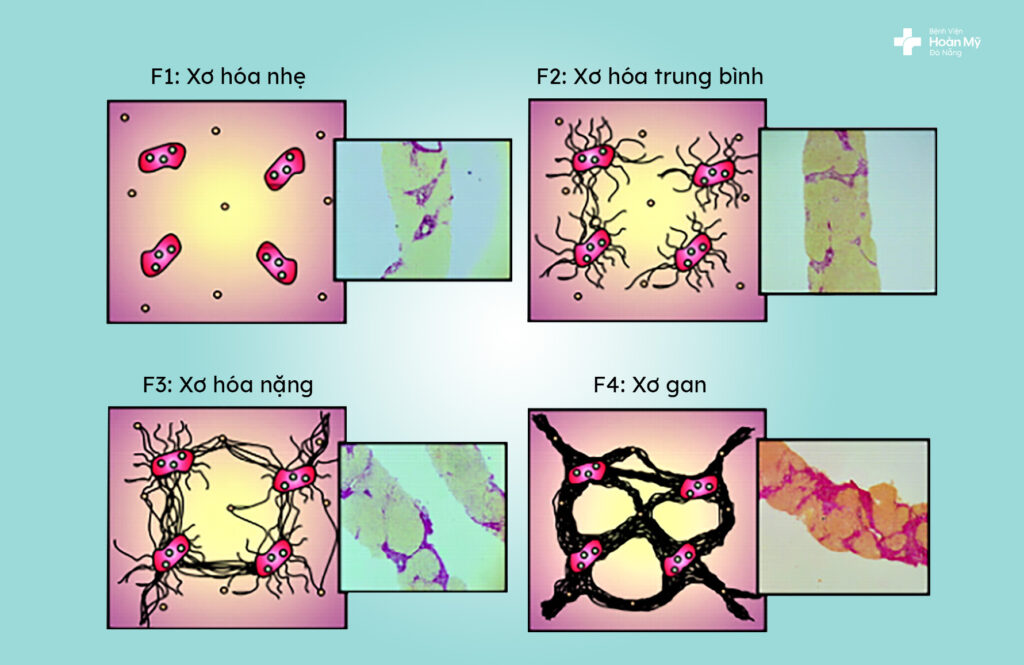 Các giai đoạn xơ hóa gan theo phân loại giải phẫu bệnh Metavir