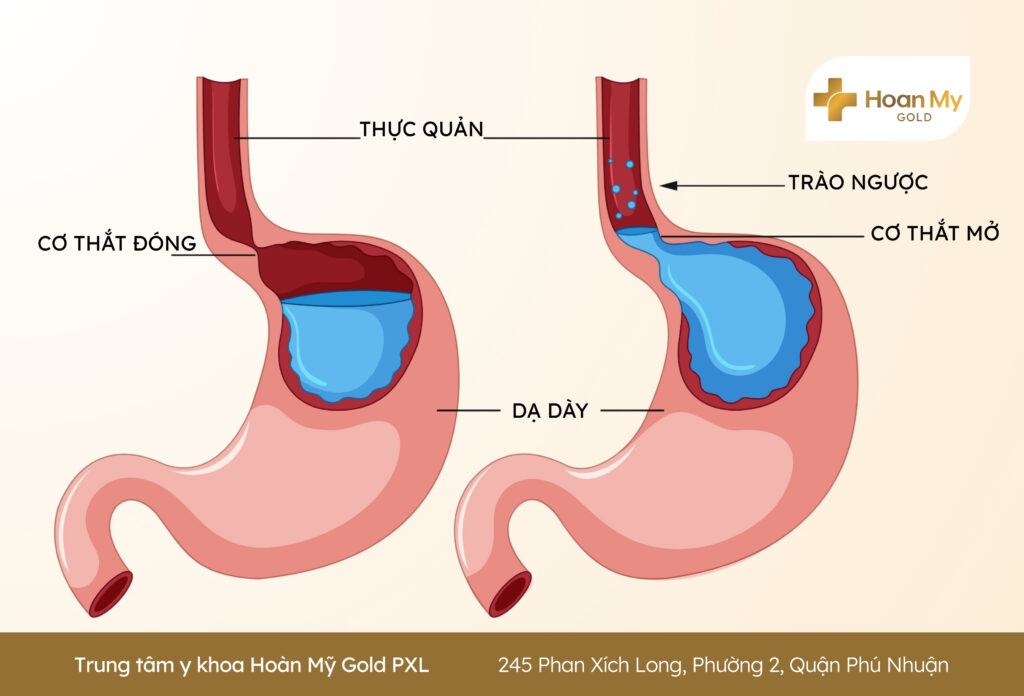Trào ngược dạ dày thực quản: Nguyên nhân và cách điều trị