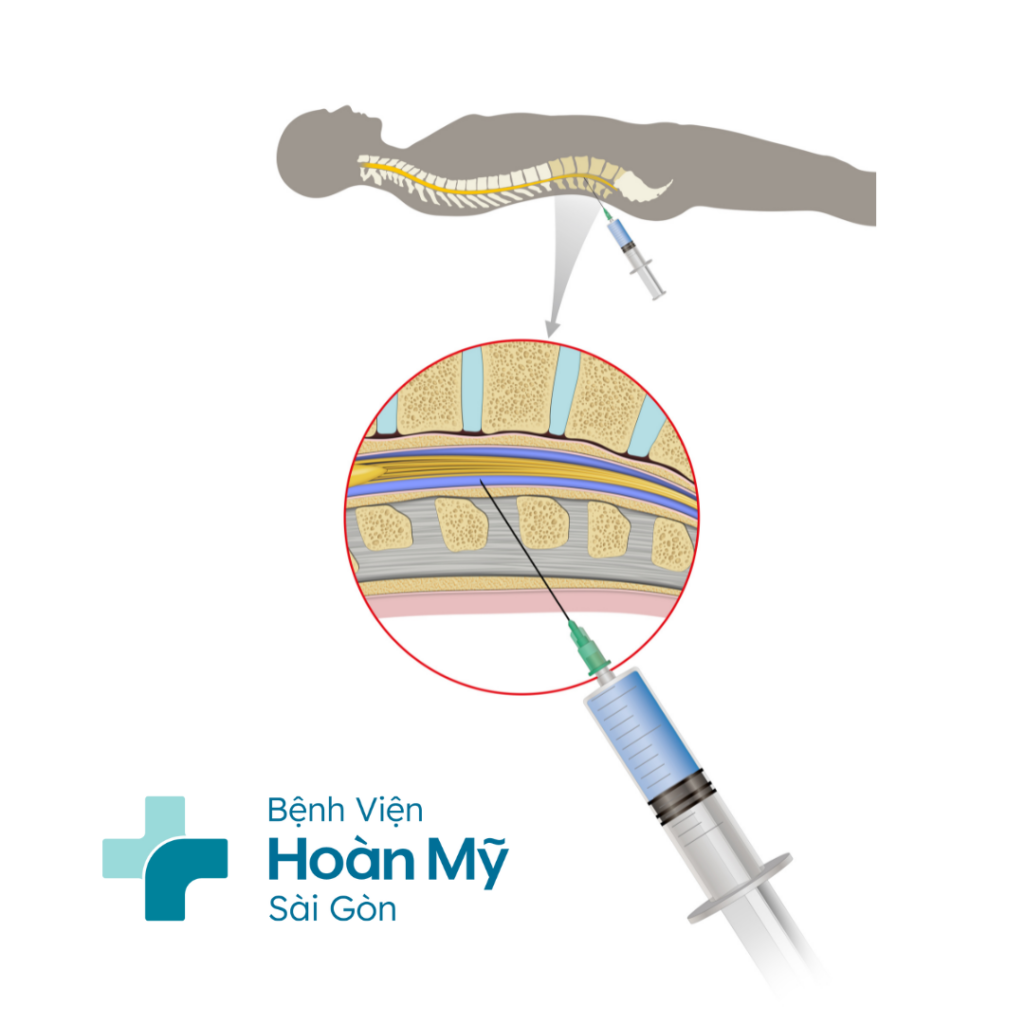 Rối loạn tri giác do nhiễm trùng ở người lớn tuổi có thể điều trị khỏi hoàn toàn nếu phát hiện sớm