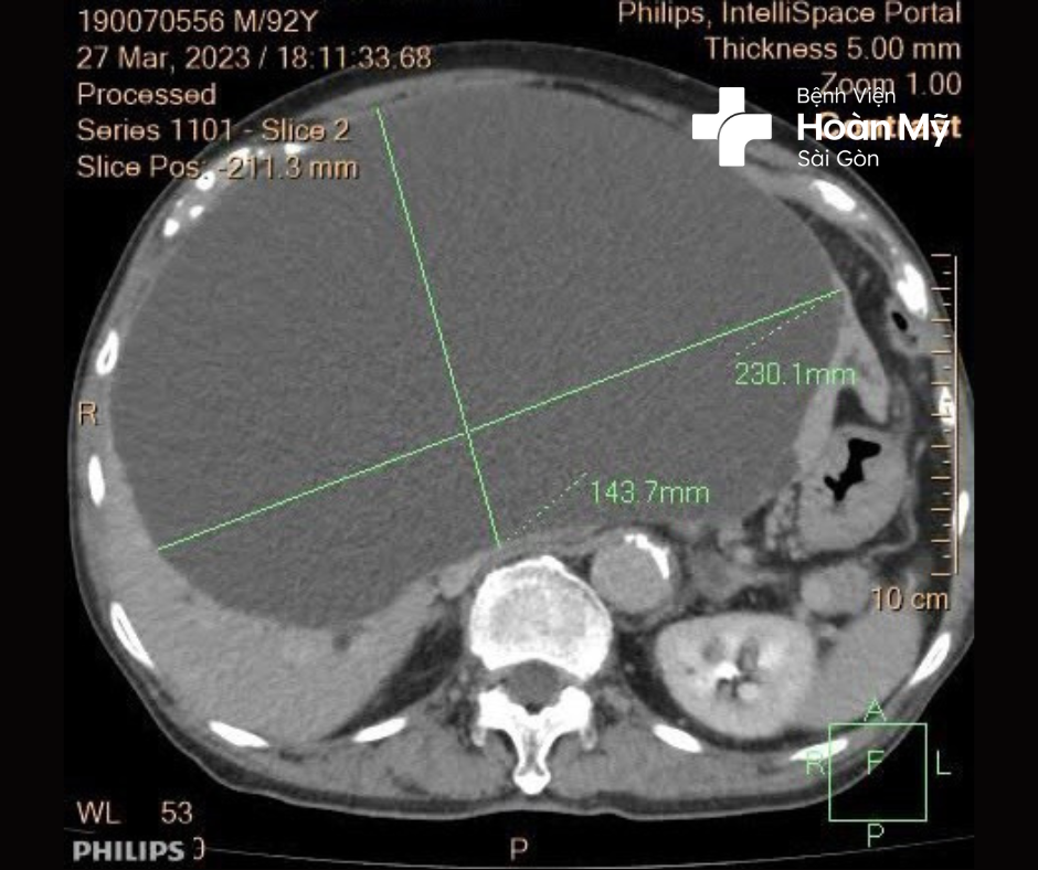 Bệnh viện kịp thời cứu sống cụ ông 93 tuổi bị nang gan lớn xuất huyết