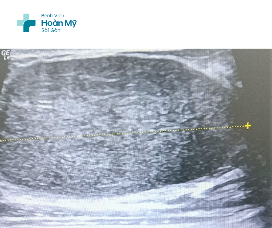 Giải phẫu thẩm mỹ không để lại sẹo bằng phương pháp sinh thiết vú hỗ trợ hút chân không (VABB)