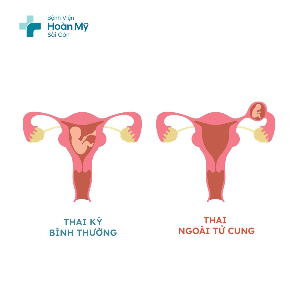 Chị em cần cẩn trọng với thai ngoài tử cung