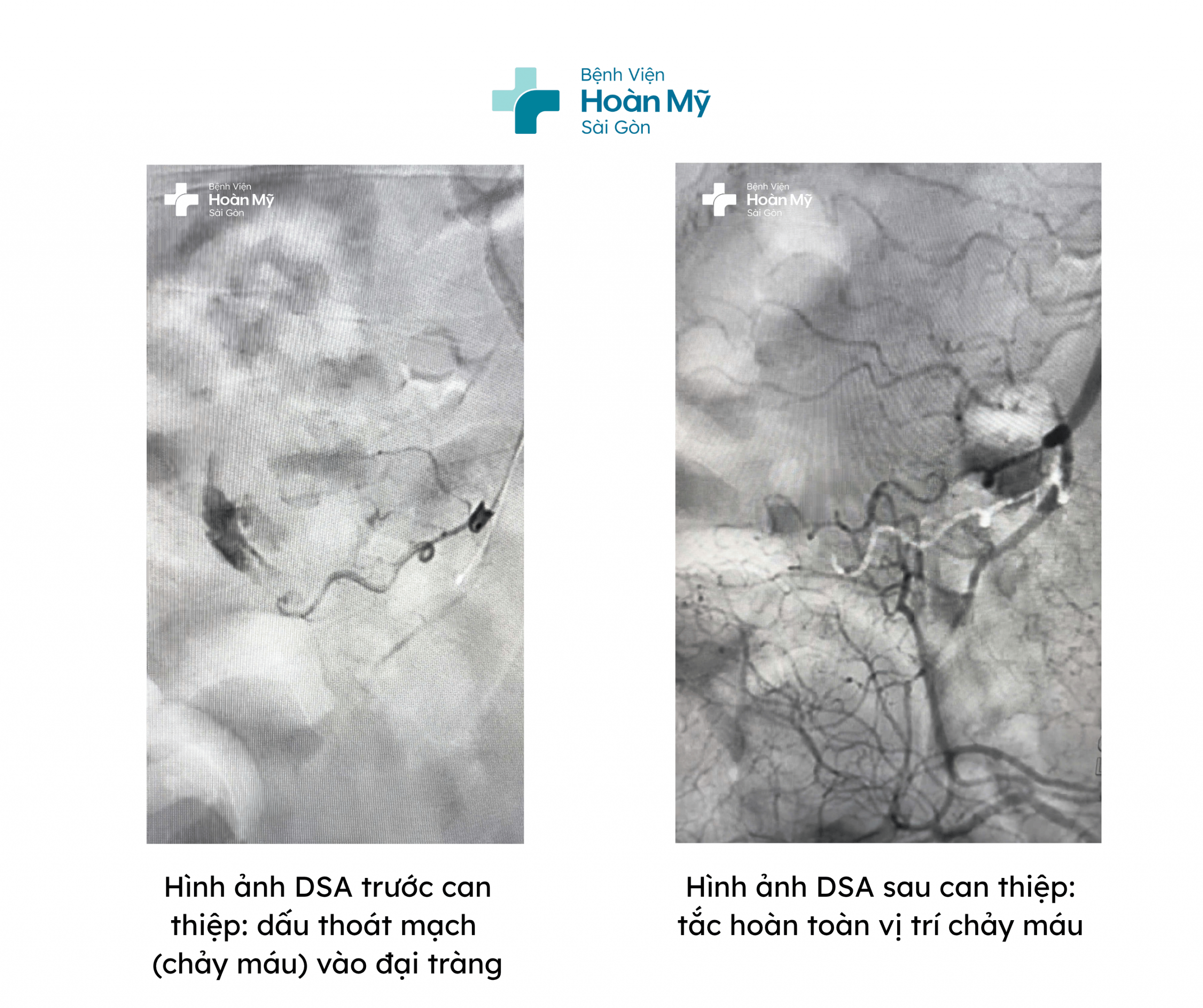 Xuất huyết tiêu hóa nặng do vỡ túi thừa đại tràng