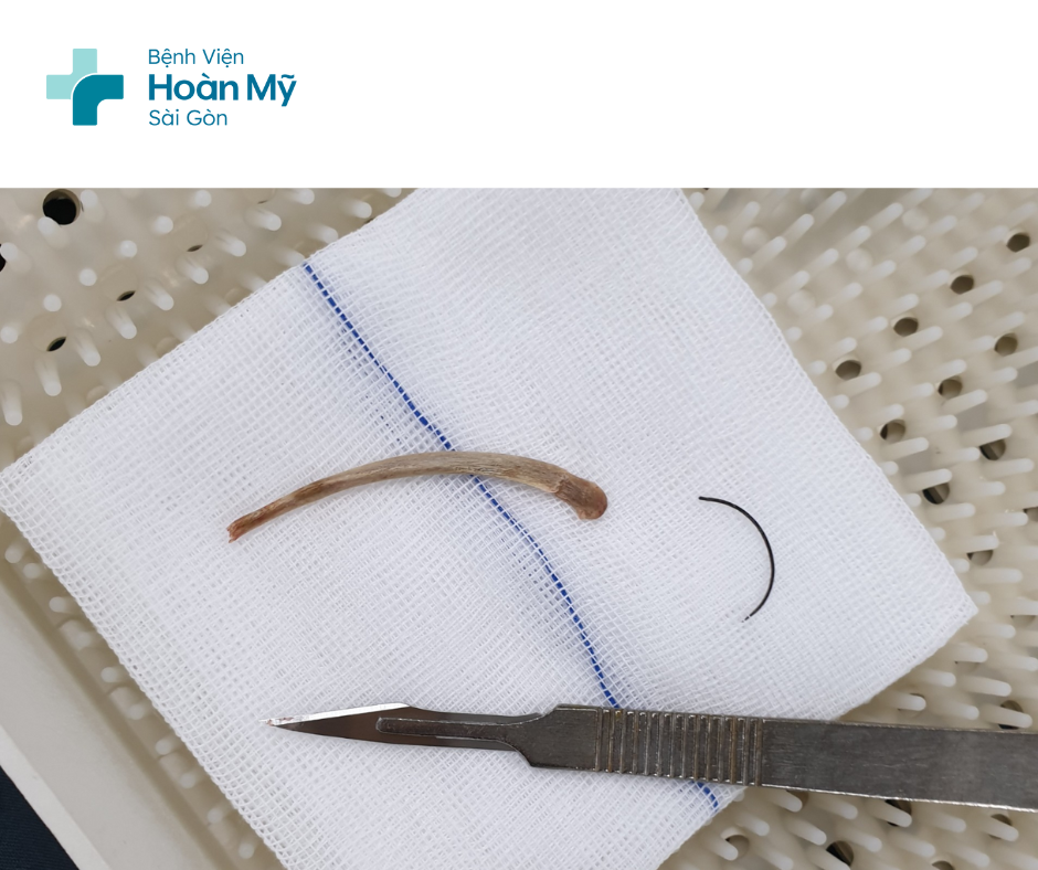 Người đàn ông ho sốt kéo dài, bác sĩ phát hiện mảnh xương dài 6cm kẹt trong phổi