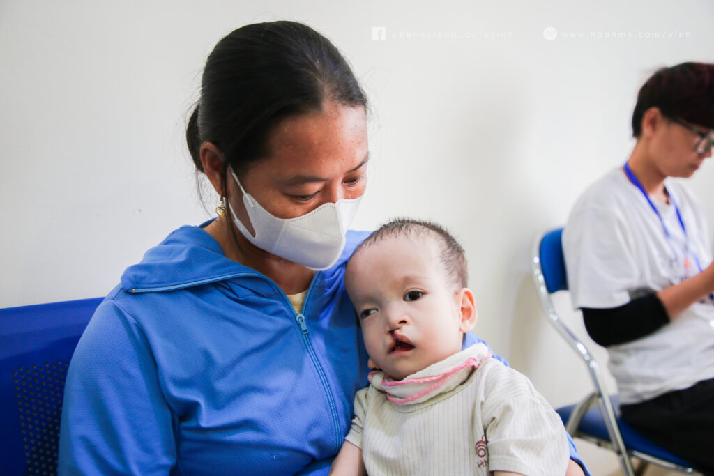 Dị tật hàm mặt (sứt môi, hở vòm)