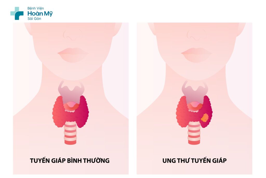 Ung thư tuyến giáp có thể phát hiện sớm thông qua tầm soát sức khỏe định kỳ