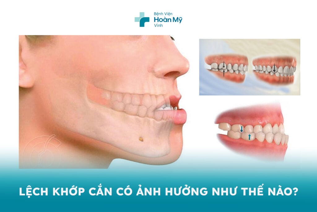 Lệch khớp cắn ảnh hưởng như thế nào?