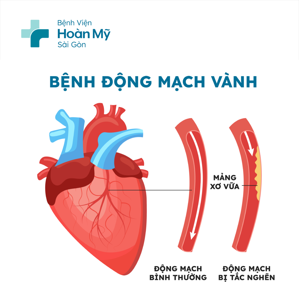 Tầm soát bệnh mạch vành