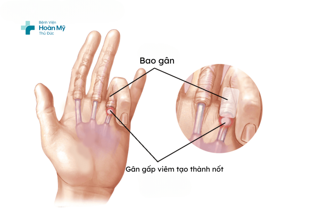Ngón tay lò xo: Hiểu về bệnh và cách điều trị