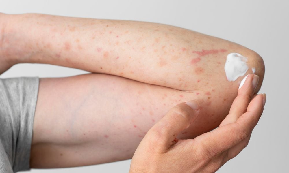 Liều dùng Nizoral cần được chỉ dẫn bởi bác sĩ