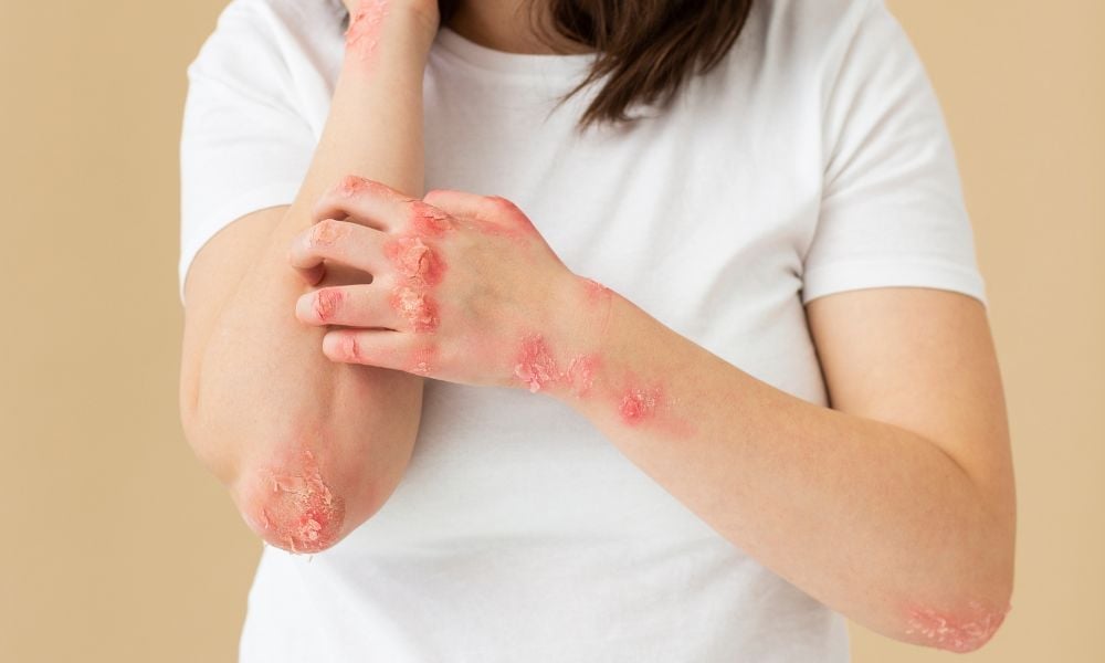 Cách dùng và liều dùng thuốc nizoral