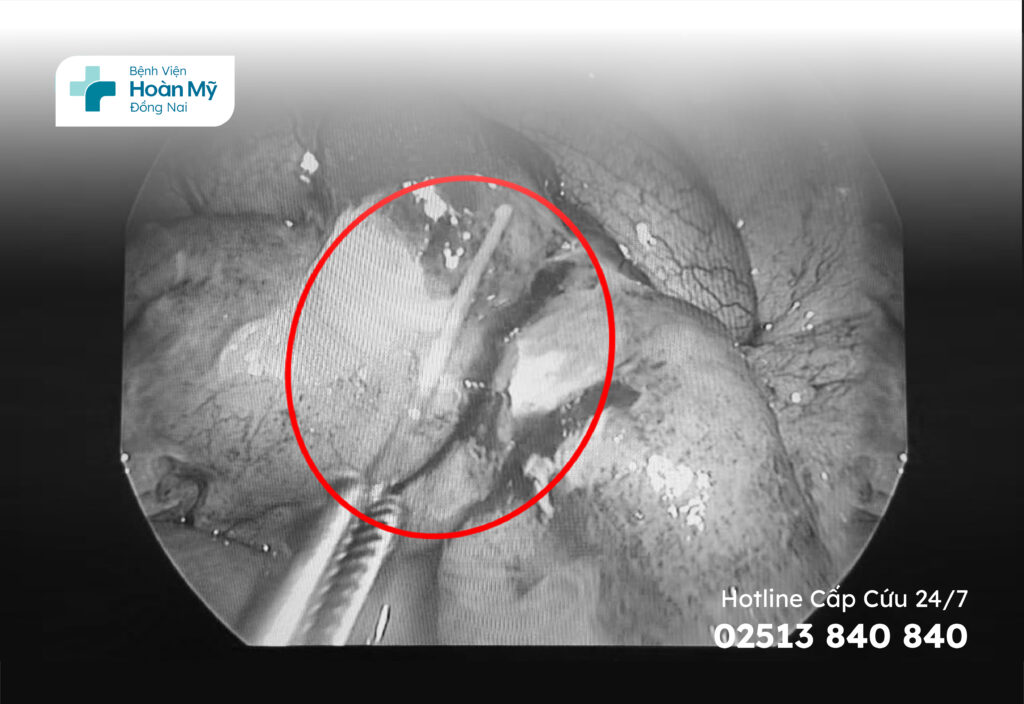 Phẫu thuật cấp cứu người bị thủng ruột do tăm tre