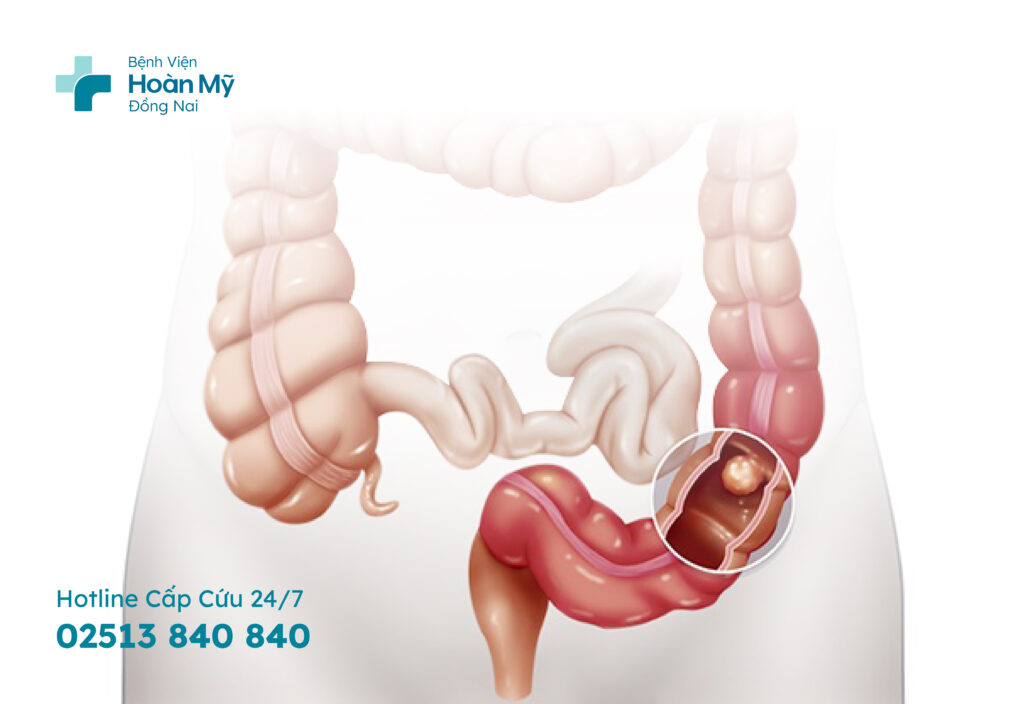 Phẫu thuật nội soi điều trị ung thư đại tràng