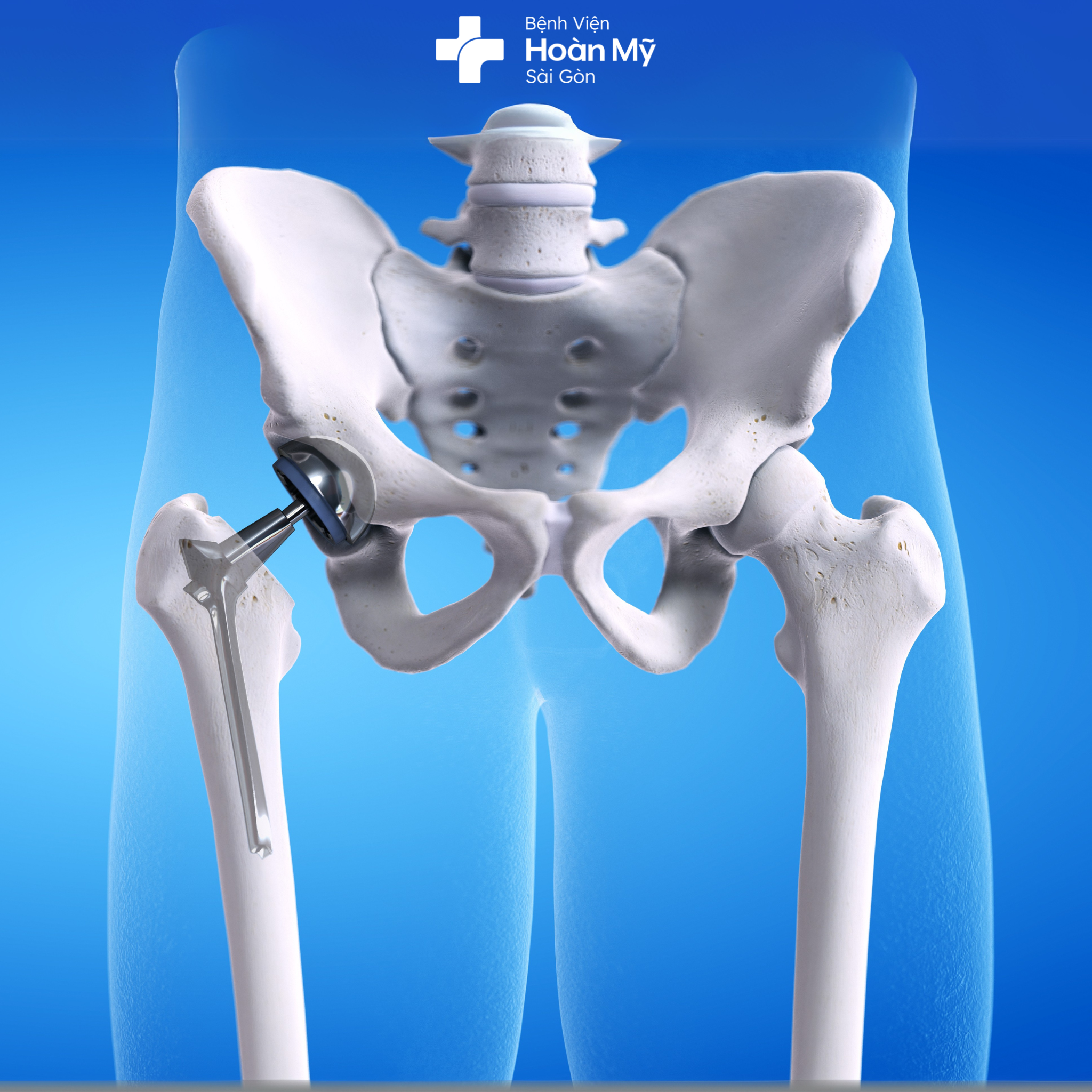 Phục hồi chức năng và phòng tránh các vấn đề sau mổ thay khớp háng  