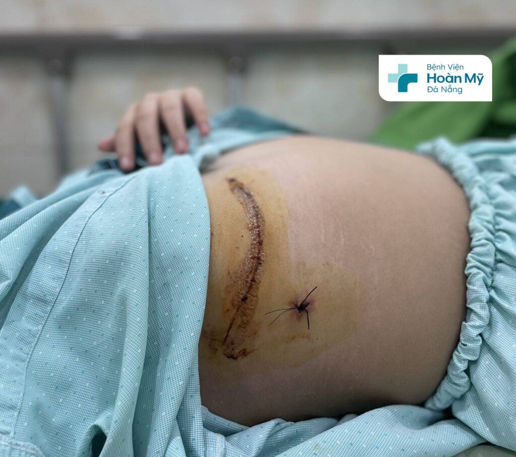 Vết mổ sau khi phẫu thuật tim bằng phương pháp nội soi ít xâm lấn