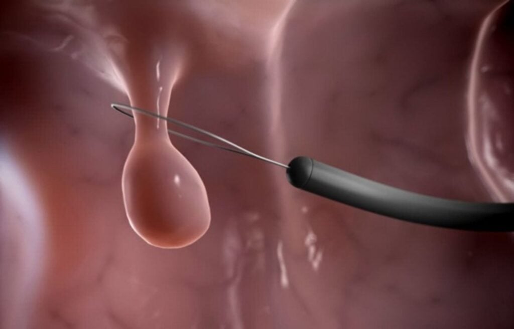 Phương pháp điều trị polyp tử cung 