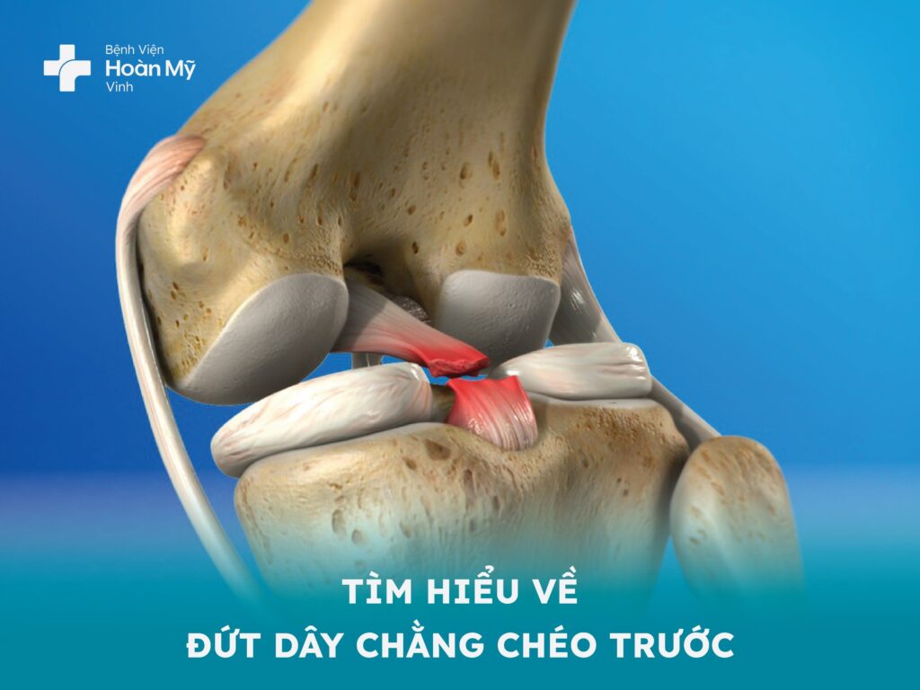 Tìm hiểu về đứt dây chằng chéo trước