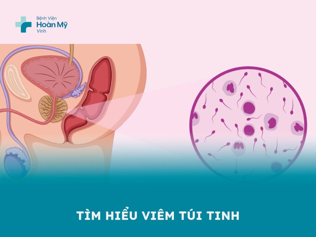 Tìm hiểu về viêm túi tinh