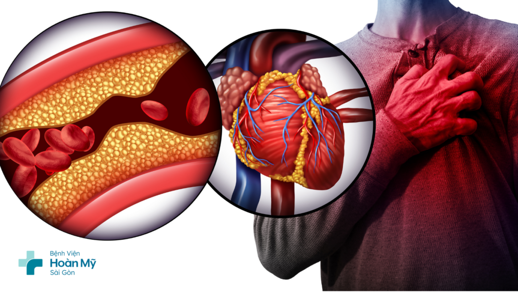 Những điều cần lưu ý về nhồi máu cơ tim