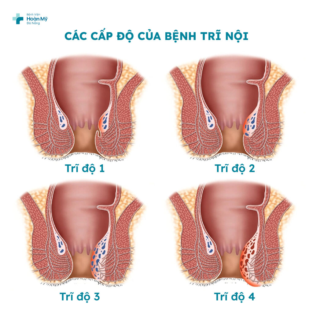 Phân loại bệnh trĩ và các phương pháp điều trị: Hiệu quả của phẫu thuật trĩ Longo
