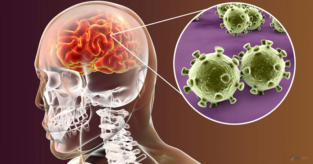 Viêm màng não là gì? 