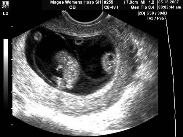 he Sonographic Evaluation Of Twin-To-Twin Transfusion Syndrome | IAME